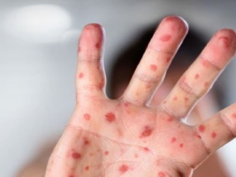 Identificaron nuevos síntomas de la viruela del mono